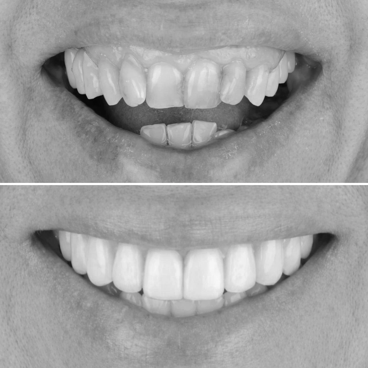 Antes