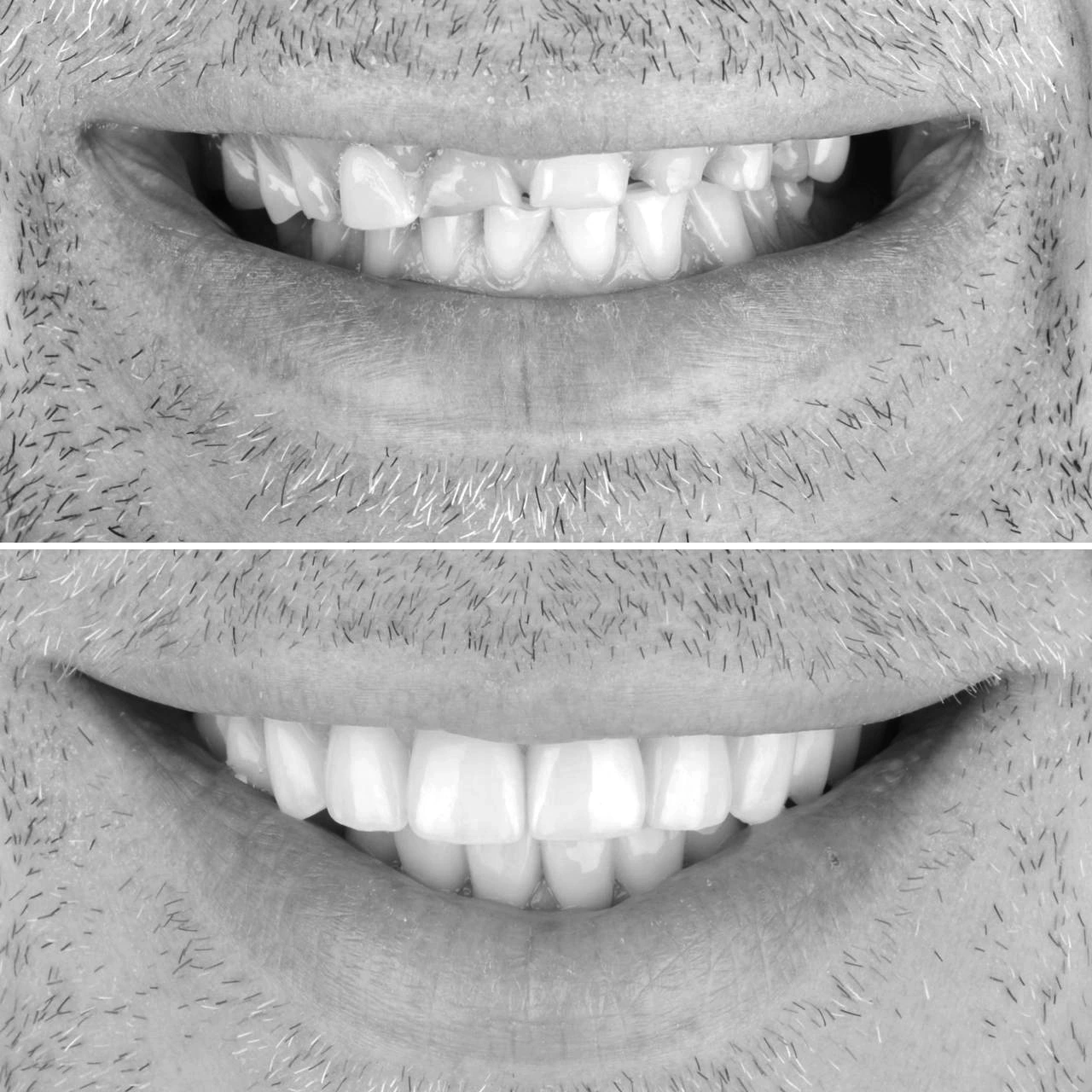 Antes
